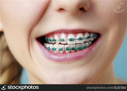 Dentist and orthodontist concept. Closeup of woman showing teeth with blue braces, making funny silly face. Closeup of woman teeth with braces, funny face