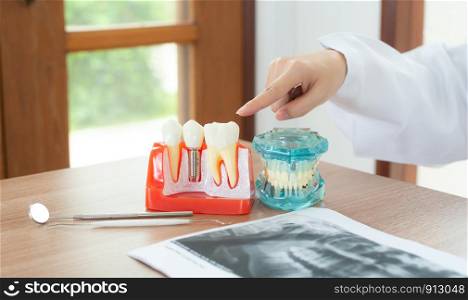 Dentist with dental implant model.