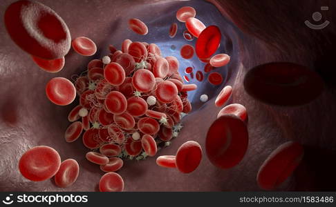 Depiction of a blood clot forming inside a blood vessel. 3D illustration. Formation of a blood clot