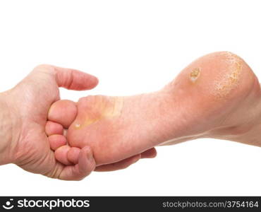Dermatologist examining a foot for callus and dry skin, towards white