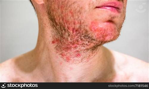 Detail of man&rsquo;s chin with seborrheic dermatitis in the beard area. Man with seborrheic dermatitis in the beard area