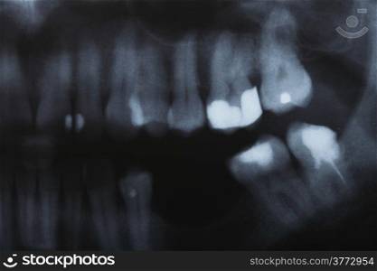 detail x-ray image scan of humans teeth