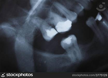 detail x-ray image scan of humans teeth