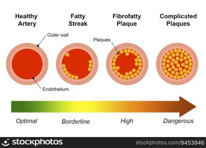 Different stages of atherosclerosis arterial disease, 3d rendering