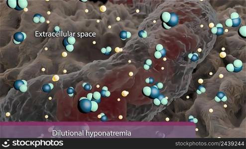 Dilutional hyponatremia, also known as water intoxication 3D illustration. Dilutional hyponatremia, also known as water intoxication