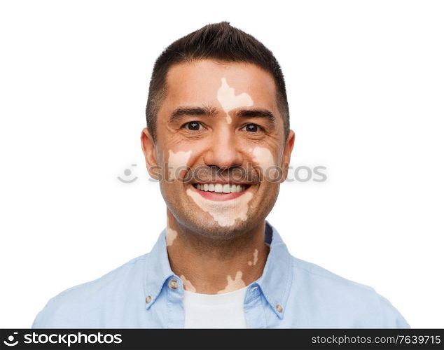diversity, skin pigmentation and people concept - happy smiling man with vitiligo. happy smiling man with vitiligo