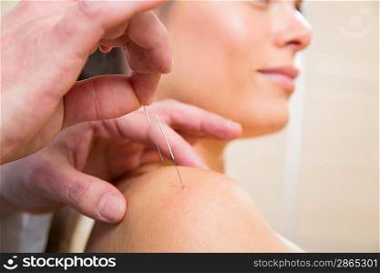 Doctor hands acupuncture needle pricking on woman patient closeup