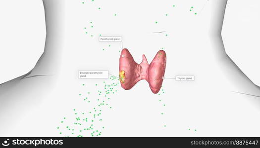 Due to their increased number of cells, enlarged parathyroid glands produce more parathyroid hormone than normal. 3D rendering. Due to their increased number of cells, enlarged parathyroid glands produce more parathyroid hormone than normal.