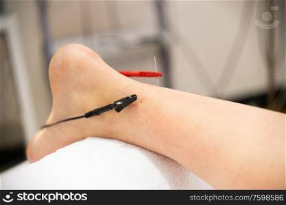 Electro-acupuncture dry with needle connecting machine. Electro stimulation in physical therapy.. Electro acupuncture dry with needle connecting machine