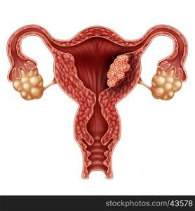 Endometrial cancer as a uterus or uterine cancer medical concept as cancerous cells in a female body attacking the reproductive system as a symbol of cervical tumor growth treatment diagnosis and symptoms with 3D illustration elements.