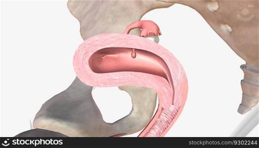 Endometrial polyps are abnormal growths of the inner lining of the uterus, known as the endometrium. 3D rendering. Endometrial polyps are abnormal growths of the inner lining of the uterus, known as the endometrium.
