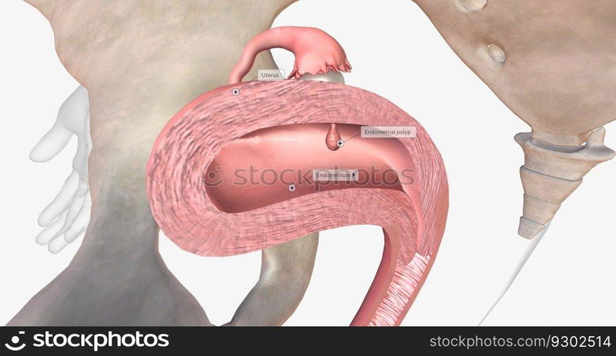 Endometrial polyps are abnormal growths of the inner lining of the uterus, known as the endometrium. 3D rendering. Endometrial polyps are abnormal growths of the inner lining of the uterus, known as the endometrium.