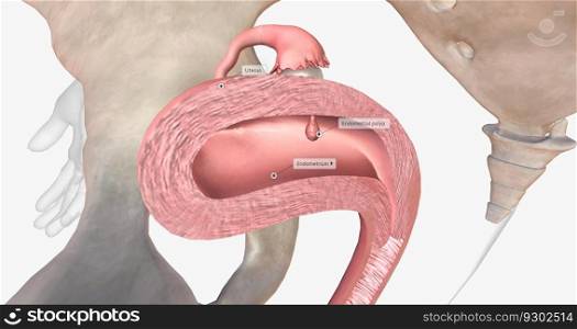 Endometrial polyps are abnormal growths of the inner lining of the uterus, known as the endometrium. 3D rendering. Endometrial polyps are abnormal growths of the inner lining of the uterus, known as the endometrium.