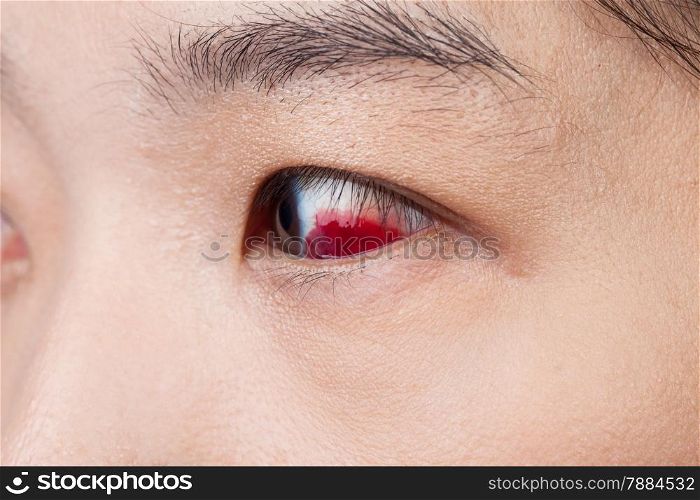 Eye injury or infected for healthy concept, macro closeup