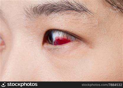Eye injury or infected for healthy concept, macro closeup