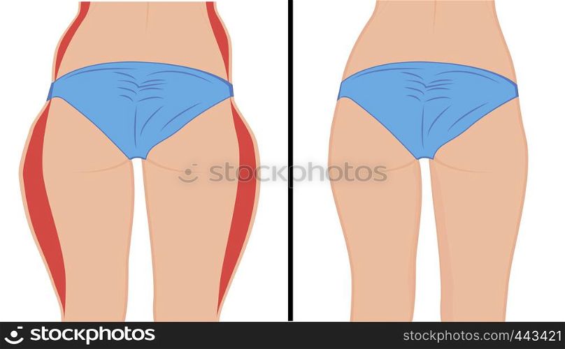 Fat and slim girl's back. Fat thig. Liposuction. Before and after. Woman body correction vector illustration