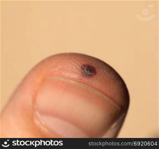 finger injury following hammer blow. blood blister on finger injuried with an accidental hammer blow