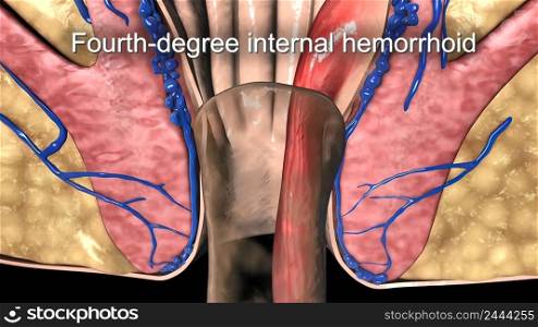 Fourth degree hemorrhoids also include hemorrhoids that are thrombosed or that pull much of the lining of the rectum through the anus. 3D Medical illustration. Hemorrhoids that prolapse and cannot be pushed back in the anal canal.
