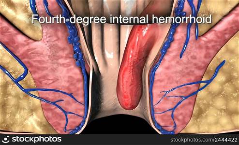 Fourth degree hemorrhoids also include hemorrhoids that are thrombosed or that pull much of the lining of the rectum through the anus. 3D Medical illustration. Hemorrhoids that prolapse and cannot be pushed back in the anal canal.