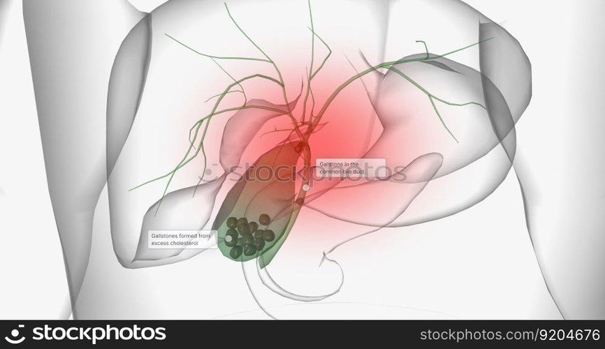 Gallstones are pieces of solid material that form in the gallbladder, a small hollow organ located beneath the liver. 3D rendering. Gallstones are pieces of solid material that form in the gallbladder, a small hollow organ located beneath the liver.