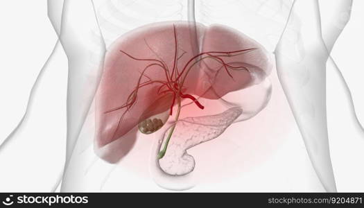 Gallstones are pieces of solid material that form in the gallbladder, a small hollow organ located beneath the liver. 3D rendering. Gallstones are pieces of solid material that form in the gallbladder, a small hollow organ located beneath the liver.