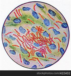 Germs of tuberculosis, vintage engraved illustration.