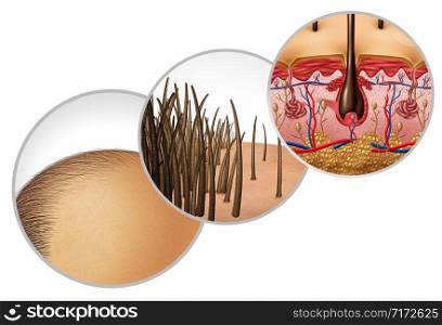 Hair loss diagram and baldness or bald head hair loss as a receding hairline cosmetic follicle thinning and alopecia as a close up of skin anatomy with 3D illustration elements.