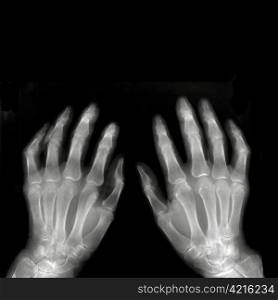 Hands on X-ray film
