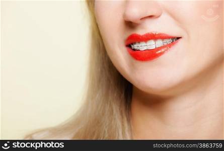Happy smiling girl with dental braces face part - teeth straighten tooth hygiene, dentistry clinic healthy lifestyle.