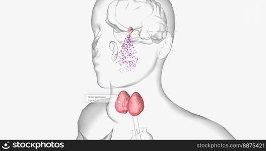 Hashimoto&rsquo;s thyroiditis is an autoimmune condition characterized by inadequate production of thyroid hormones. 3D rendering. Hashimoto&rsquo;s thyroiditis is an autoimmune condition characterized by inadequate production of thyroid hormones.