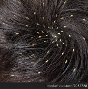 Head lice medical concept with a close up of a human head with an infestation of parasitic nits or eggs hatching near the scalp from a louse as a symbol of diagnosis prevention and treatment for children and adults.