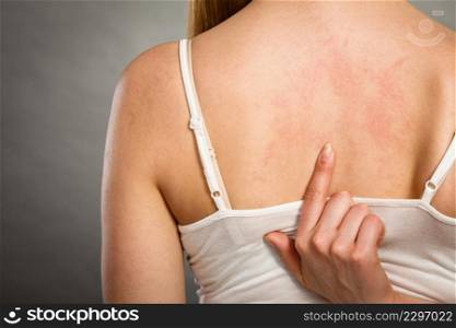Health problem, skin diseases. Young woman showing her itchy back with allergy rash urticaria symptoms. woman scratching her itchy back with allergy rash