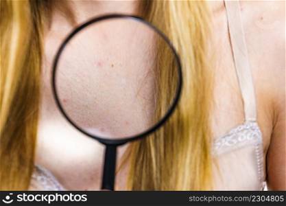 Health problem, skin diseases. Young woman showing her neckline with acne, red spots. Female with pimples.. Woman with skin problem acne on neckline