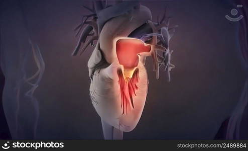 heart valve inflammation 3D illustration. heart valve inflammation 3d medical