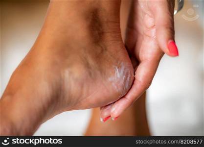 Heel repair treatment cream. Woman applying repair cream on heels.. Heel treatment cream. 