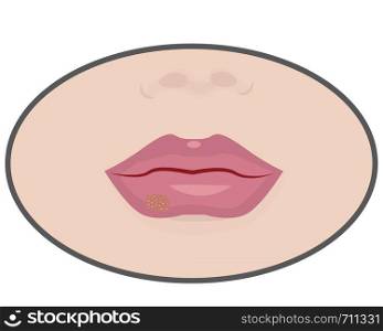 Herpes cold sores on lips vector illustration on a white background isolated