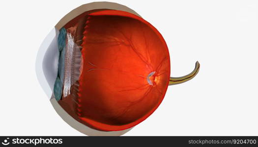 Higher than normal intraocular pressure in the absence of ocular hypertension, optic nerve damage, or visual field loss 3D rendering. Higher than normal intraocular pressure in the absence of ocular hypertension, optic nerve damage, or visual field loss