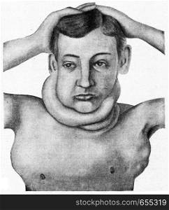 Hodgkin's disease, vintage engraved illustration.