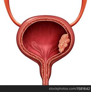 Human bladder cancer as a urinary anatomical organ disease and malignant cells concept as a 3D illustration cutaway of body anatomy.