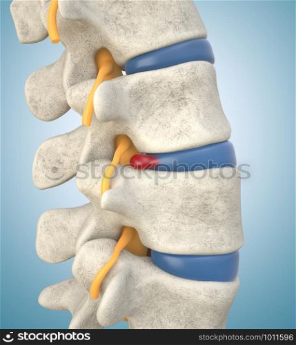 Human lumbar spine model demonstrating herniated disc, pressure nerve root causing back pain. 3D illustration. Human lumbar spine model with herniated disc