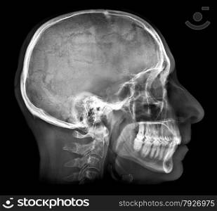 Human skull X-ray image isolated on black. Human skull X-ray image