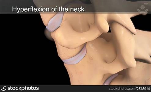 hyperflexion of the neck 3d illustration. hyperflexion of the neck 3d