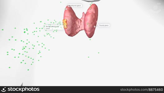 Hyperparathyroidism is a condition in which high amounts of parathyroid hormone are produced by the parathyroid gland. 3D rendering. Hyperparathyroidism is a condition in which high amounts of parathyroid hormone are produced by the parathyroid gland.