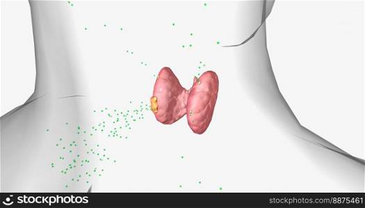 Hyperparathyroidism is a condition in which high amounts of parathyroid hormone are produced by the parathyroid gland. 3D rendering. Hyperparathyroidism is a condition in which high amounts of parathyroid hormone are produced by the parathyroid gland.