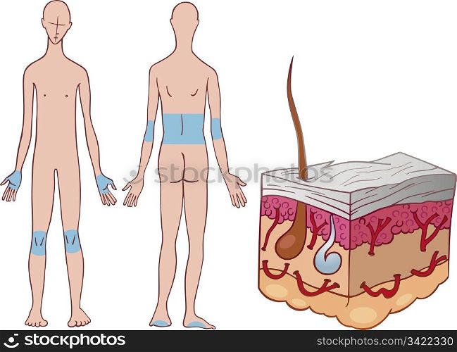Illustration of psoriasis skin disease