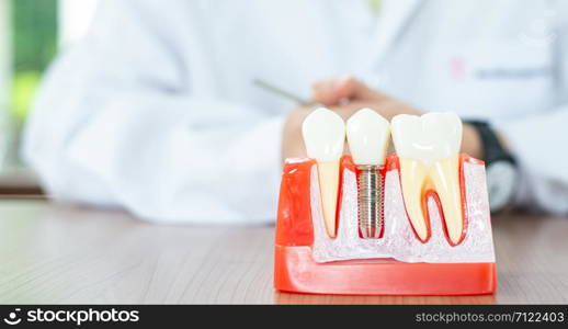 Implant dental model in dental care concept.