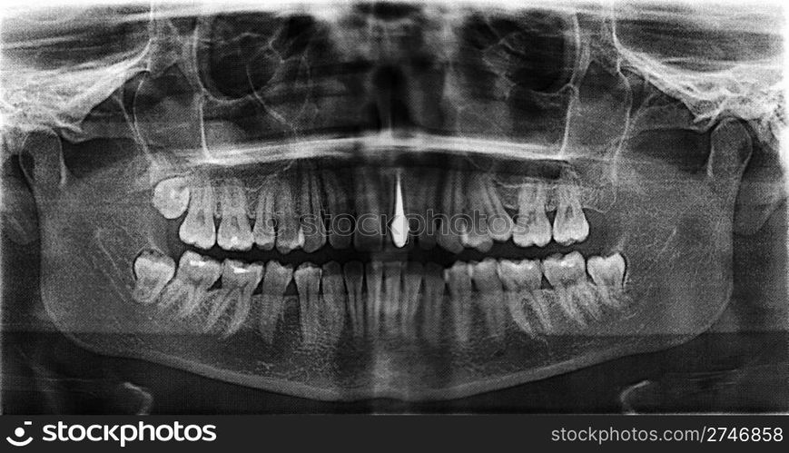 Implanted tooth on a steel pin. X-ray of female jaw. Scanned from the film