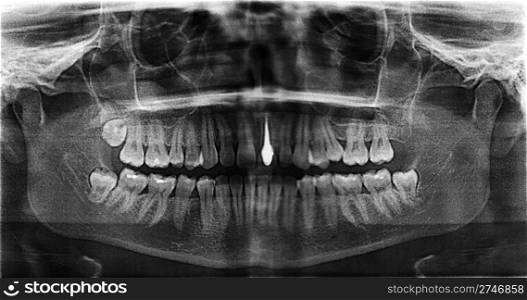 Implanted tooth on a steel pin. X-ray of female jaw. Scanned from the film