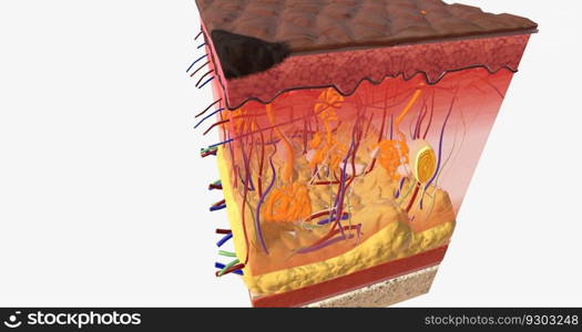 In Stage I ALM, the tumor is very small and located on the top-most layer of the skin, the epidermis. 3D rendering. In Stage I ALM, the tumor is very small and located on the top-most layer of the skin, the epidermis.