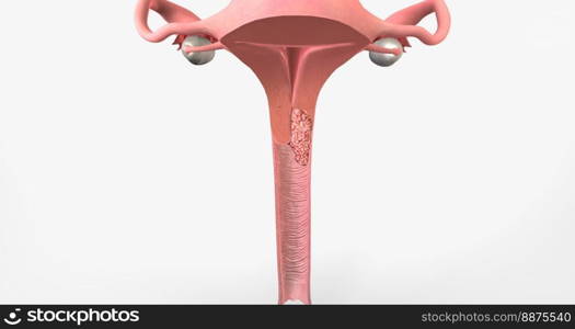 In stage II, the cancer has invaded the upper part of the vagina and tissue near the uterus called the parametrium.3D rendering. In stage II, the cancer has invaded the upper part of the vagina and tissue near the uterus called the parametrium.